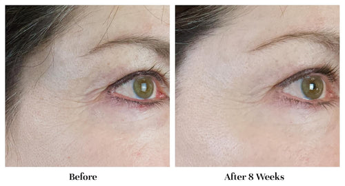 Face & Neck Wrinkle Remover