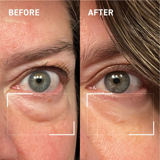 Lid Lifting Treatment