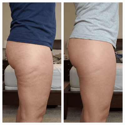 Anti-Cellulite Massage Oil